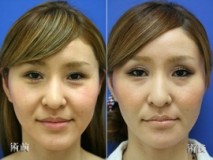 アゴ削り ヴェリィ美容形成クリニック 京都の美容整形 美容外科